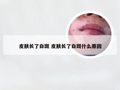 皮肤长了白斑 皮肤长了白斑什么原因