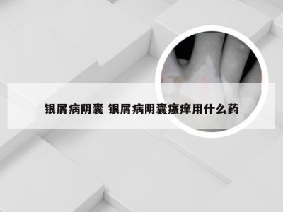 银屑病阴囊 银屑病阴囊瘙痒用什么药