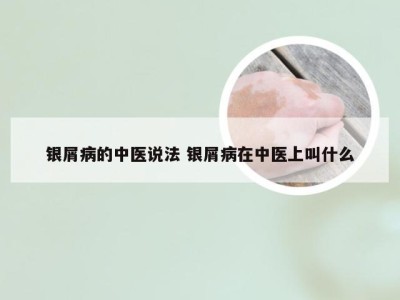 银屑病的中医说法 银屑病在中医上叫什么