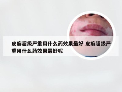 皮癣超级严重用什么药效果最好 皮癣超级严重用什么药效果最好呢