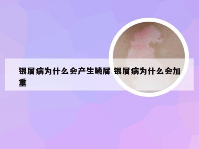 银屑病为什么会产生鳞屑 银屑病为什么会加重