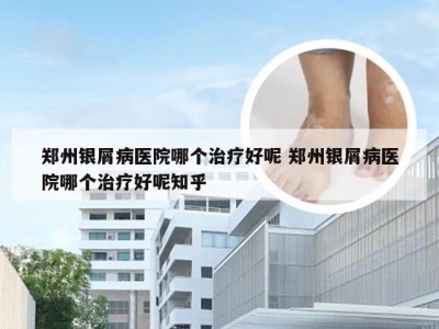 郑州银屑病医院哪个治疗好呢 郑州银屑病医院哪个治疗好呢知乎