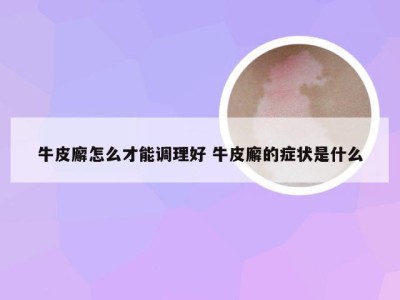 牛皮廨怎么才能调理好 牛皮廨的症状是什么