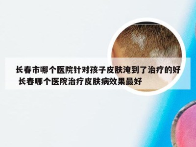 长春市哪个医院针对孩子皮肤淹到了治疗的好 长春哪个医院治疗皮肤病效果最好