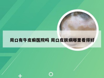 周口有牛皮癣医院吗 周口皮肤病哪里看得好