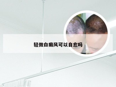 轻微白癜风可以自愈吗