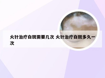 火针治疗白斑需要几次 火针治疗白斑多久一次