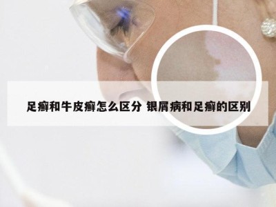 足癣和牛皮癣怎么区分 银屑病和足癣的区别