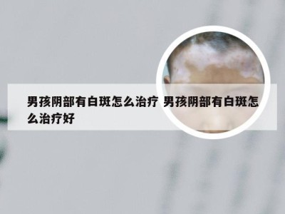 男孩阴部有白斑怎么治疗 男孩阴部有白斑怎么治疗好