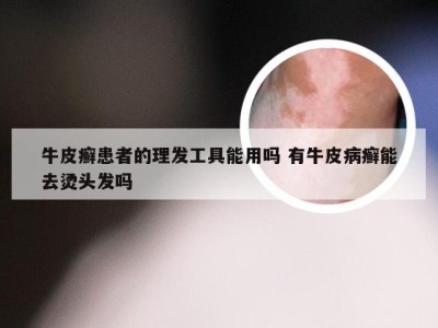 牛皮癣患者的理发工具能用吗 有牛皮病癣能去烫头发吗