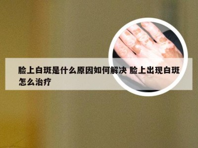 脸上白斑是什么原因如何解决 脸上出现白斑怎么治疗