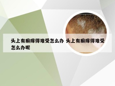 头上有癣痒得难受怎么办 头上有癣痒得难受怎么办呢