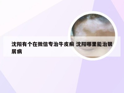 沈阳有个在微信专治牛皮癣 沈阳哪里能治银屑病