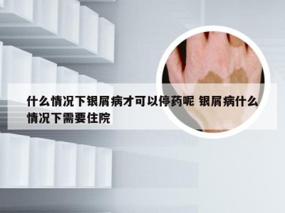 什么情况下银屑病才可以停药呢 银屑病什么情况下需要住院