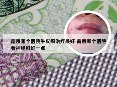 南京哪个医院牛皮癣治疗最好 南京哪个医院看神经科好一点