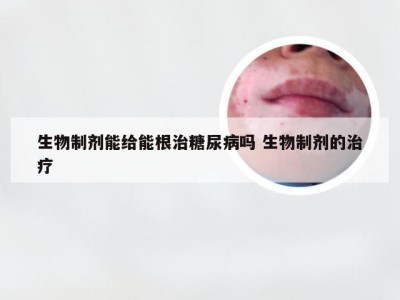 生物制剂能给能根治糖尿病吗 生物制剂的治疗