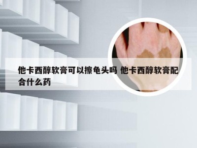 他卡西醇软膏可以擦龟头吗 他卡西醇软膏配合什么药