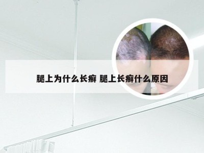 腿上为什么长癣 腿上长癣什么原因