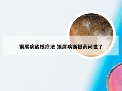 银屑病截根疗法 银屑病断根药问世了