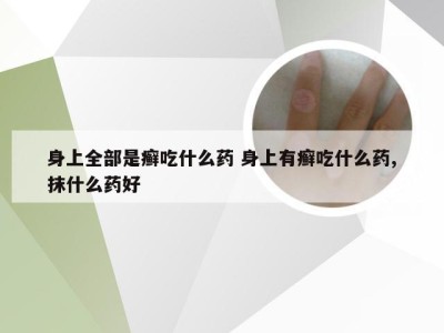 身上全部是癣吃什么药 身上有癣吃什么药,抹什么药好