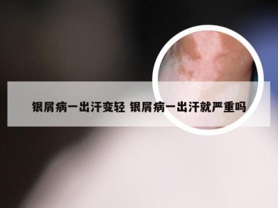 银屑病一出汗变轻 银屑病一出汗就严重吗