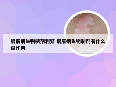 银屑病生物制剂利弊 银屑病生物制剂有什么副作用