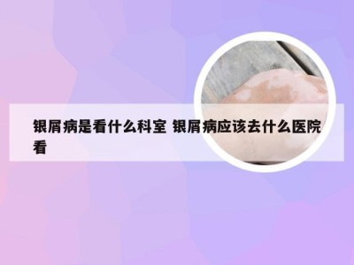 银屑病是看什么科室 银屑病应该去什么医院看