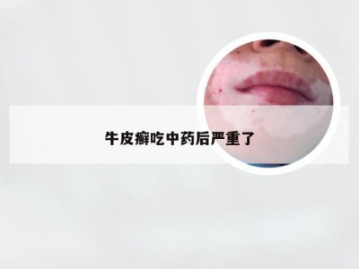 牛皮癣吃中药后严重了