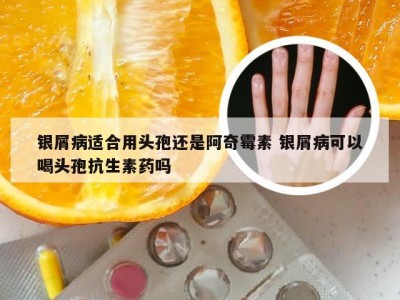 银屑病适合用头孢还是阿奇霉素 银屑病可以喝头孢抗生素药吗