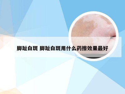 脚趾白斑 脚趾白斑用什么药擦效果最好