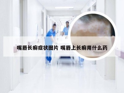 嘴唇长癣症状图片 嘴唇上长癣用什么药