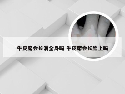 牛皮廨会长满全身吗 牛皮廨会长脸上吗