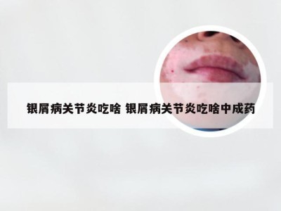 银屑病关节炎吃啥 银屑病关节炎吃啥中成药