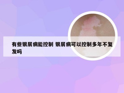 有些银屑病能控制 银屑病可以控制多年不复发吗