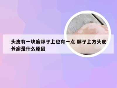 头皮有一块癣脖子上也有一点 脖子上方头皮长癣是什么原因