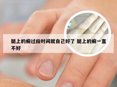 腿上的癣过段时间就自己好了 腿上的癣一直不好