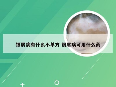 银屑病有什么小单方 银屑病可用什么药