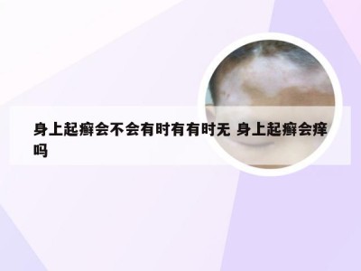 身上起癣会不会有时有有时无 身上起癣会痒吗