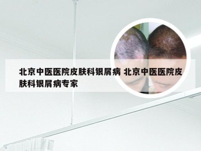 北京中医医院皮肤科银屑病 北京中医医院皮肤科银屑病专家