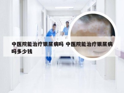 中医院能治疗银屑病吗 中医院能治疗银屑病吗多少钱