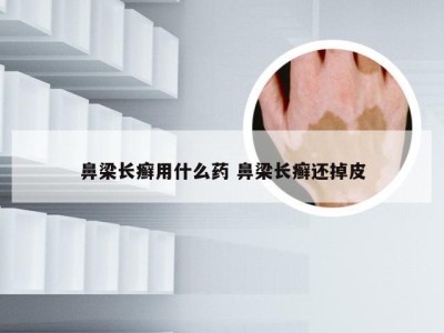 鼻梁长癣用什么药 鼻梁长癣还掉皮