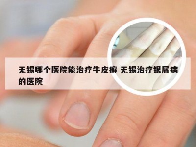 无锡哪个医院能治疗牛皮癣 无锡治疗银屑病的医院