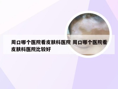 周口哪个医院看皮肤科医院 周口哪个医院看皮肤科医院比较好