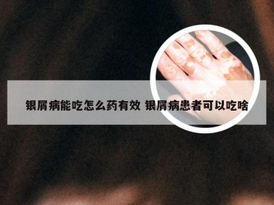 银屑病能吃怎么药有效 银屑病患者可以吃啥