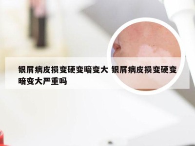 银屑病皮损变硬变暗变大 银屑病皮损变硬变暗变大严重吗