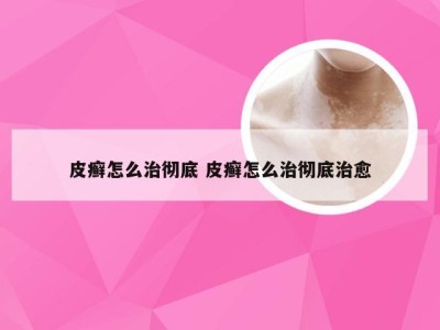 皮癣怎么治彻底 皮癣怎么治彻底治愈