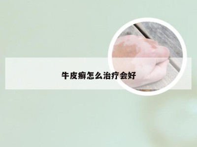 牛皮癣怎么治疗会好