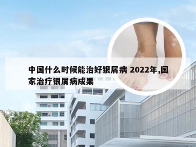 中国什么时候能治好银屑病 2022年,国家治疗银屑病成果