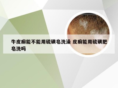 牛皮癣能不能用硫磺皂洗澡 皮癣能用硫磺肥皂洗吗