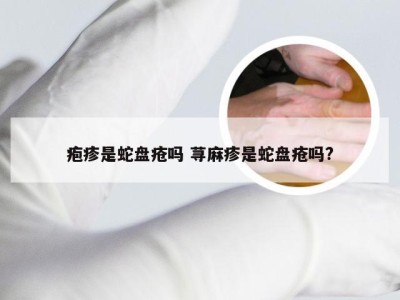 疱疹是蛇盘疮吗 荨麻疹是蛇盘疮吗?